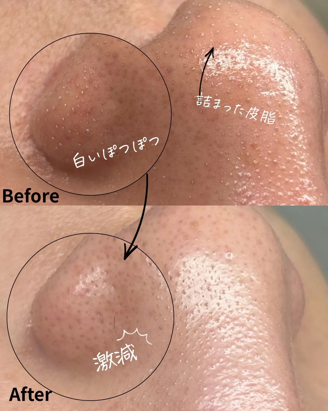 鼻の毛穴...どおしたらいいの??