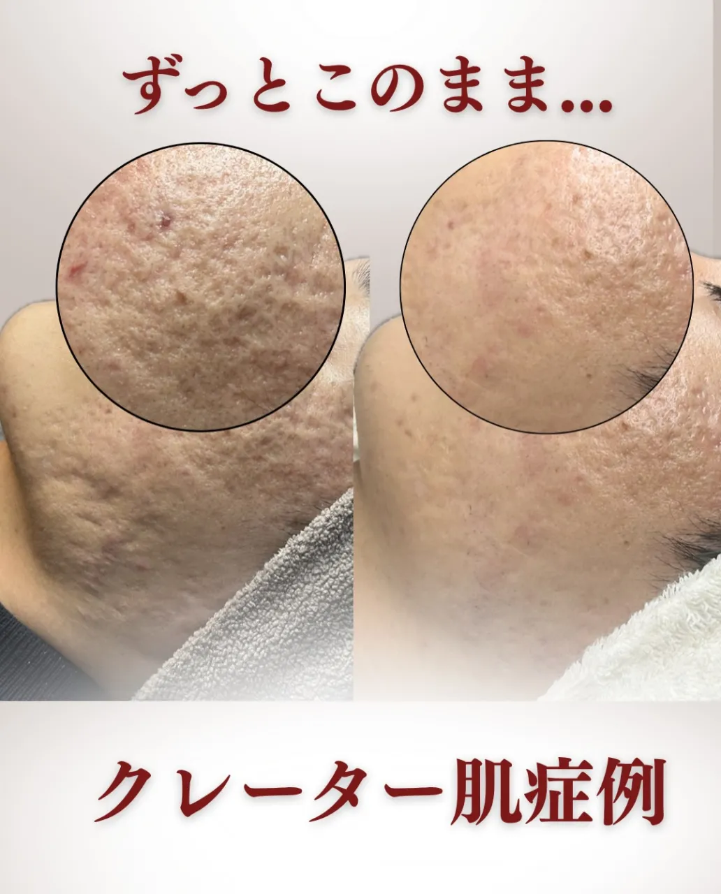 【広島市中区ニキビ跡でお悩みの方に】