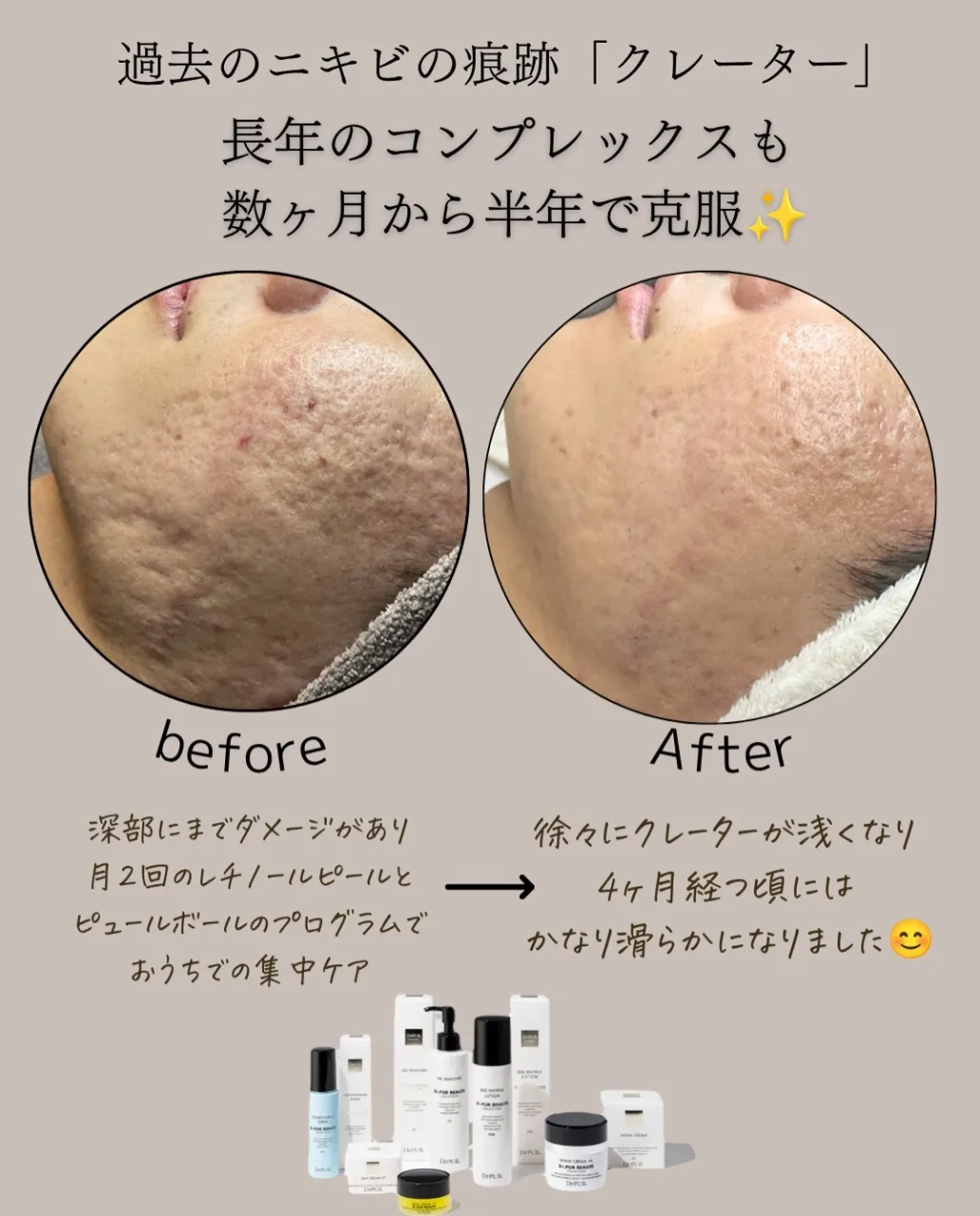 【広島市中区ニキビ跡でお悩みの方に】